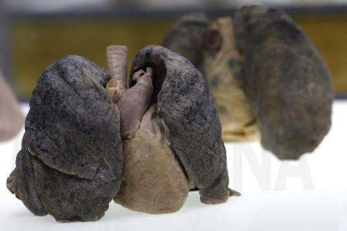 epa13116879 A smoker's lung specimen is displayed at the Museum of Human Body in Chulalongkorn University in Bangkok, Thailand, 17 July 2026. Opened in mid-2012, Thailand's Museum of Human Body is one of eleven such museums globally and the first in Southeast Asia exhibiting 131 donated specimens preserved through plastination imported from Japan of human...